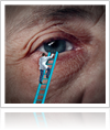 Types of Cataracts