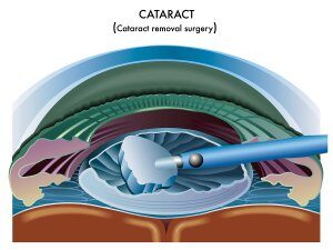 Cataract Surgery Procedure from Gerstein Eye Institute of Chicago