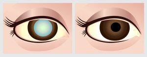 Gerstein Eye Institute Cataract Basics in Chicago