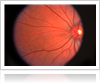 Macular degeneration treatment in Chicago